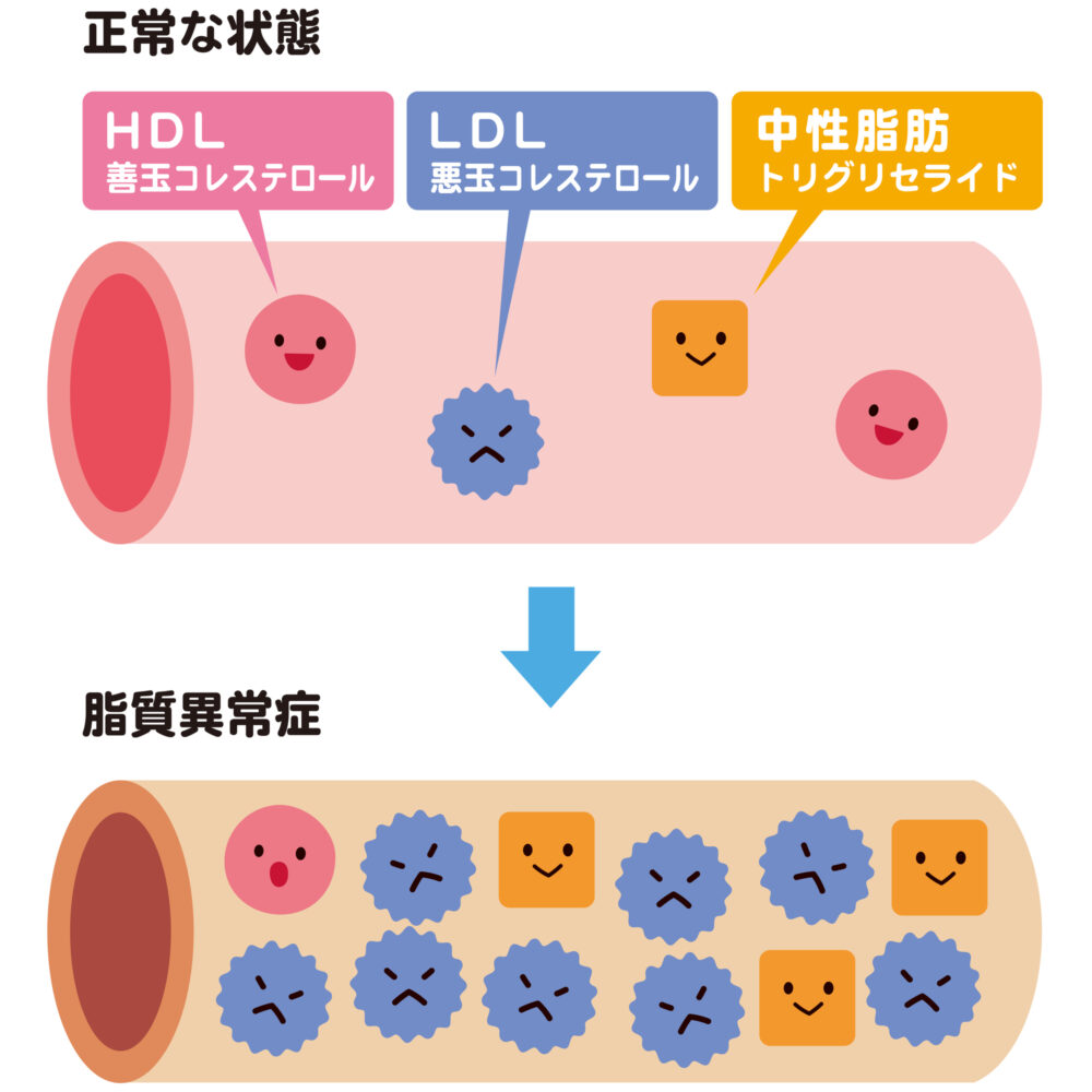 脂質異常症のメカニズム