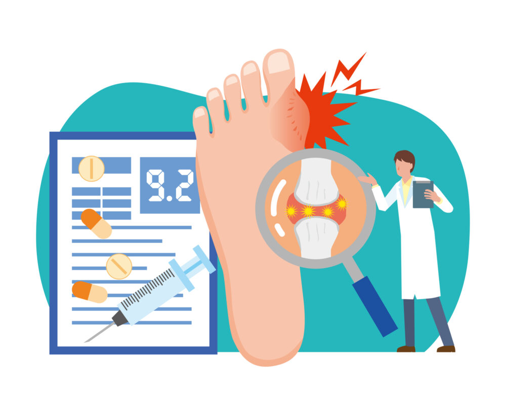 高尿酸血症（痛風）